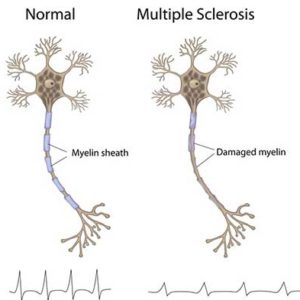 comparison between a normal myelin sheath and a damaged myelin